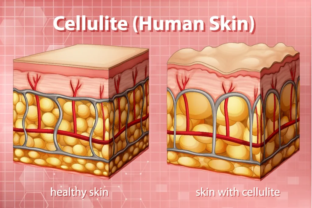Cellulite